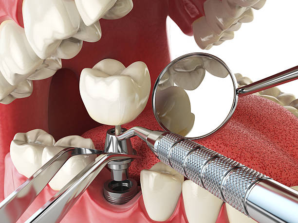 Best Emergency Root Canal Treatment in Ada, OH